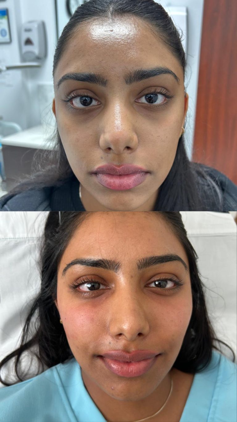 Why Natural Gel Fillers Are the Modern Choice in Aesthetic Treatments