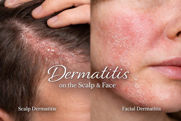 Dermatitis on the Scalp & Face: How Facials and Scalp Treatments Can Help