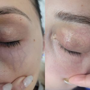 Why Choose Fotona YAG Laser for Veins Treatment?