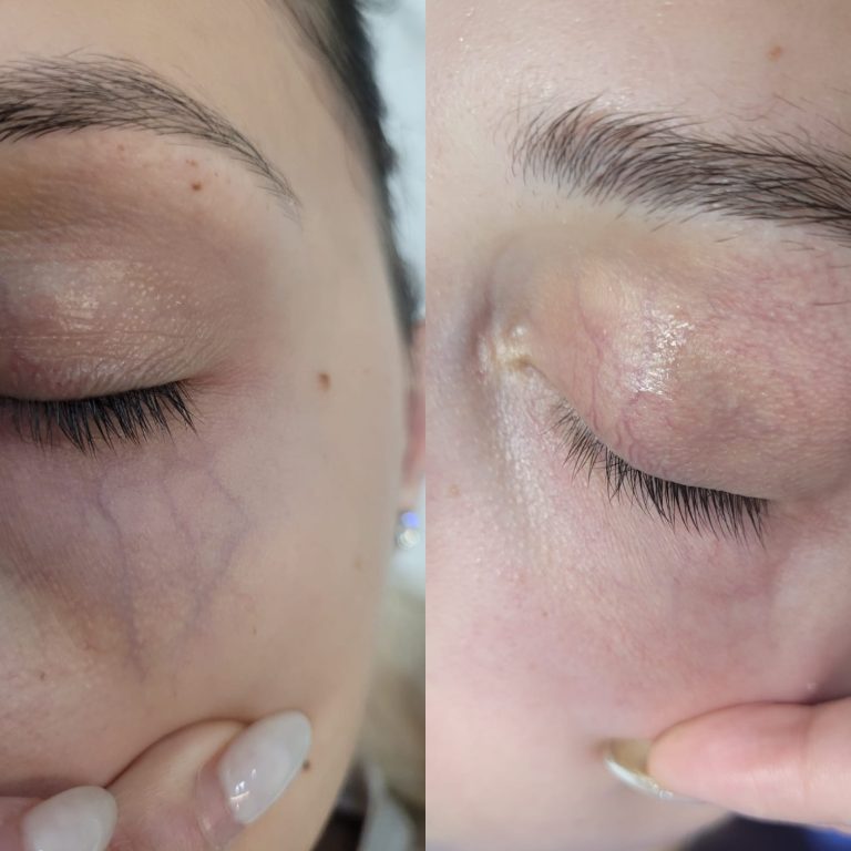 Why Choose Fotona YAG Laser for Veins Treatment?