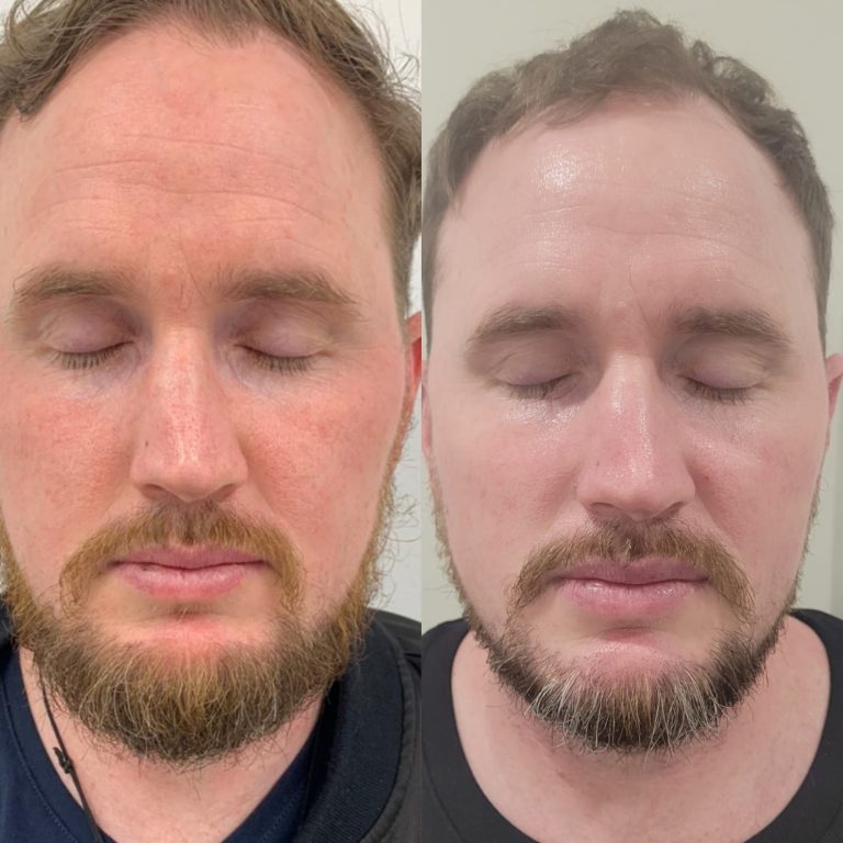 The Benefits of Skin Tightening + FRAC3 Combo (Fotona Laser)